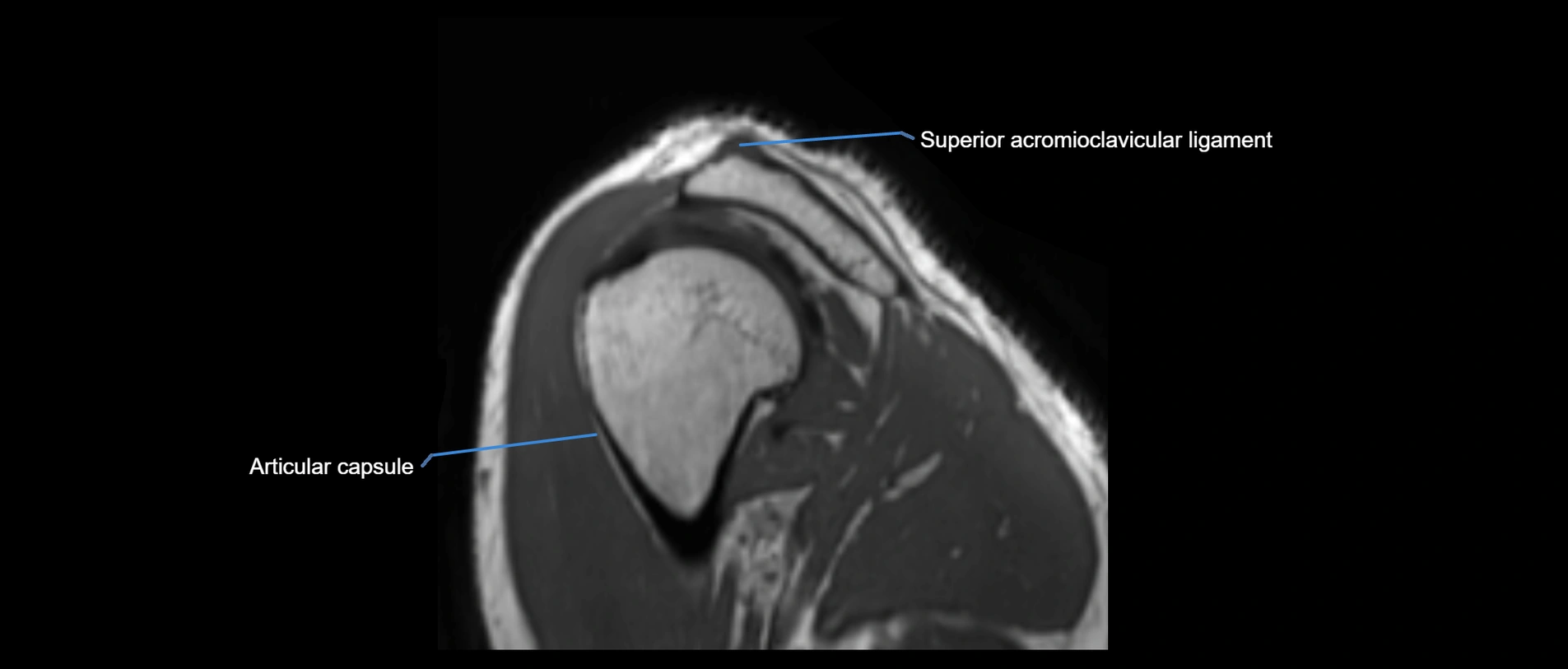 shoulder ligaments sagittal  cross sectional anatomy 3T MRI AI enhanced radiology image -img-00001-00047.webp